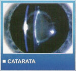 catarata
