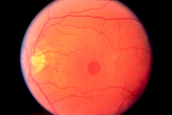 cirugía de agujero macular