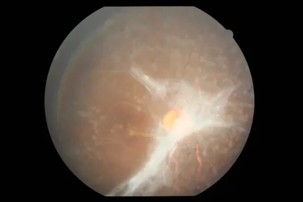 examen de retinopatía diabética