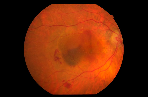 Examen de degeneración macular relacionada con la edad